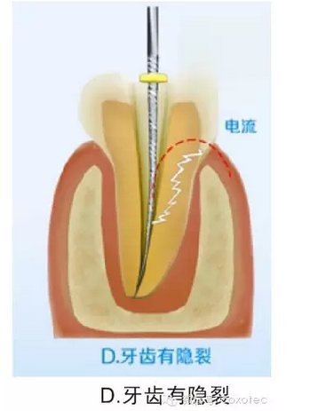 讓你知道根管測量受影響的原因