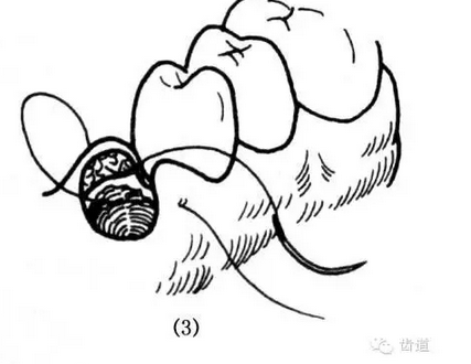 牙醫(yī)基本技能：口內(nèi)縫合術(shù)（文字、示意圖及視頻）