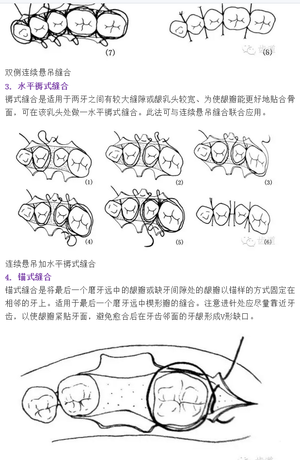 牙醫(yī)基本技能：口內(nèi)縫合術(shù)（文字、示意圖及視頻）