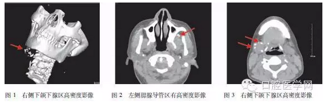 	下頜下靜脈畸形伴多發(fā)靜脈石誤診為涎石病1例