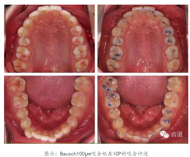 牙科咬合紙的用法