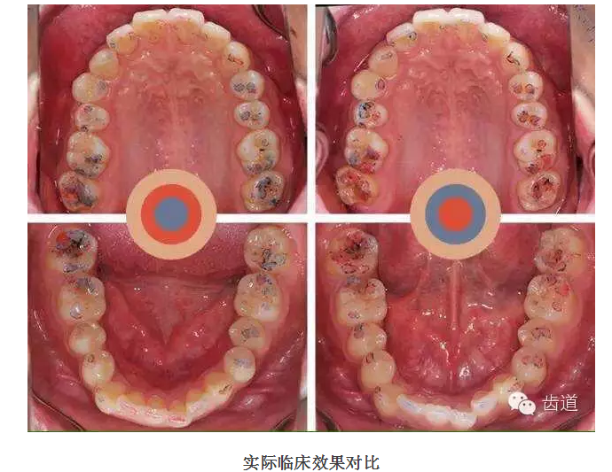 牙科咬合紙的用法