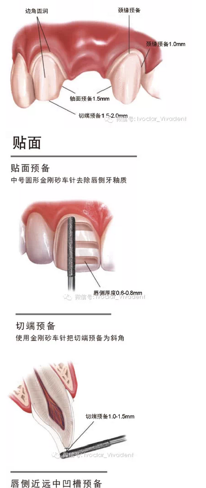 時(shí)常搞不清楚怎么備牙嗎？義獲嘉教您如何完美備牙