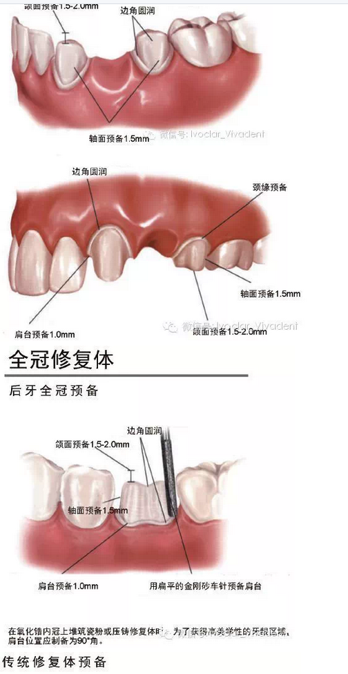 時(shí)常搞不清楚怎么備牙嗎？義獲嘉教您如何完美備牙