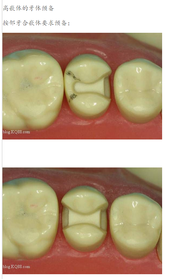 嵌體牙體預(yù)備方法