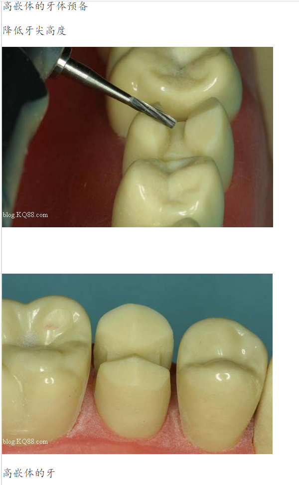 嵌體牙體預(yù)備方法