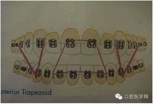 正畸damon system橡皮筋(elastics)掛法示意圖