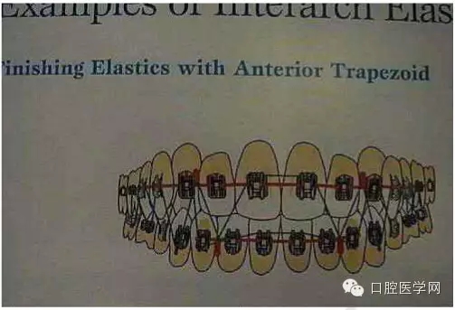 正畸damon system橡皮筋(elastics)掛法示意圖