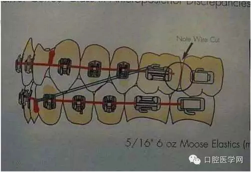 正畸damon system橡皮筋(elastics)掛法示意圖