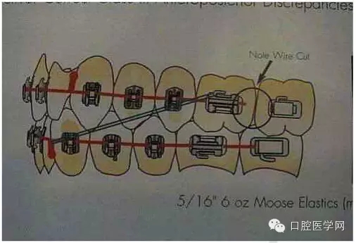 正畸damon system橡皮筋(elastics)掛法示意圖