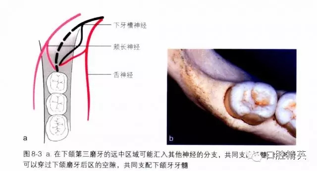 分析局部麻醉失敗的常見原因