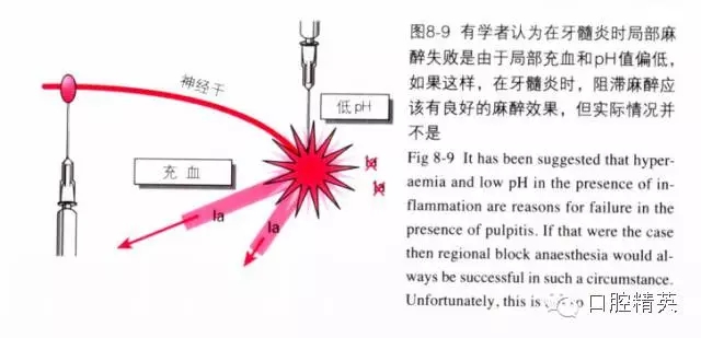 分析局部麻醉失敗的常見原因