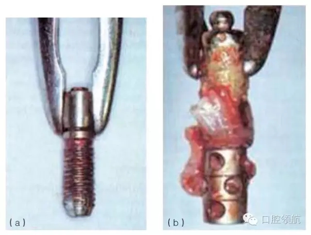 種植體失敗的病因和危險因素