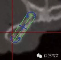 口腔種植各種失敗模式的病因探查