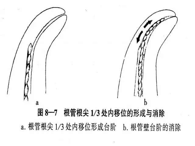 根管治療并發(fā)癥及處理