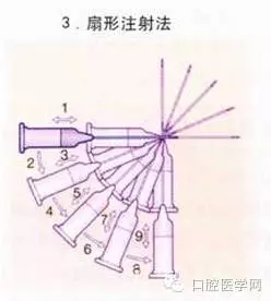 即使是老手也會失手的麻醉----下牙槽、舌、頰一次阻滯麻醉