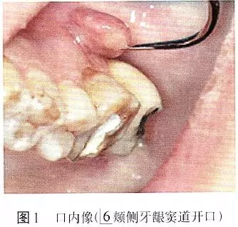 根管治療