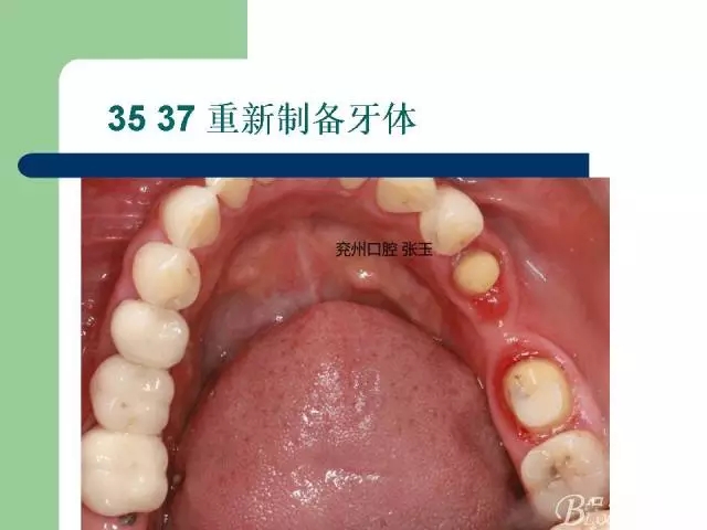 左下后牙不良修復(fù)體拆除后重新修復(fù)一例