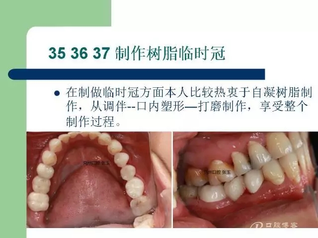 左下后牙不良修復(fù)體拆除后重新修復(fù)一例