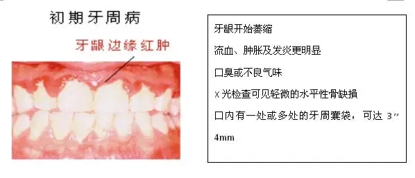 【科普】牙周病的預(yù)防和治療