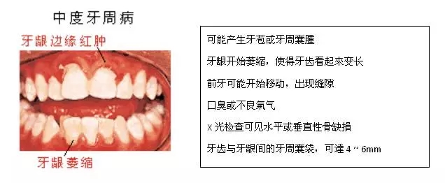 【科普】牙周病的預(yù)防和治療