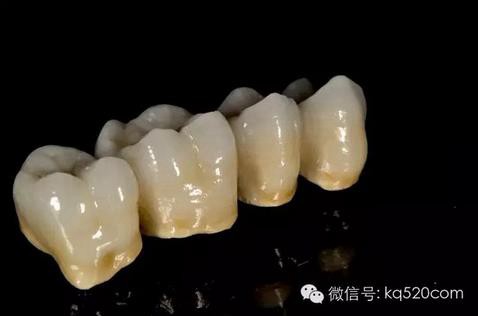 烤瓷牙邊緣變黑，要換新的嗎？