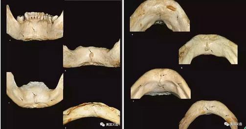 牙醫(yī)引以為戒——日本植牙手術(shù)死亡事件