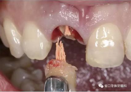 右上前牙即刻種植即刻修復(fù)1例