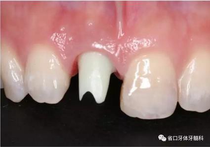 右上前牙即刻種植即刻修復(fù)1例