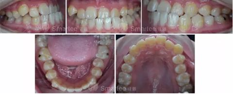 【病例展示】Smartee隱形正畸中國(guó)好病例鑒賞第三波