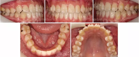 【病例展示】Smartee隱形正畸中國(guó)好病例鑒賞第三波