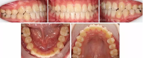 【病例展示】Smartee隱形正畸中國(guó)好病例鑒賞第三波