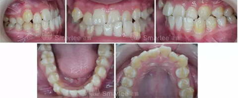 【病例展示】Smartee隱形正畸中國(guó)好病例鑒賞第三波