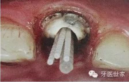 纖維樁臨床操作步驟