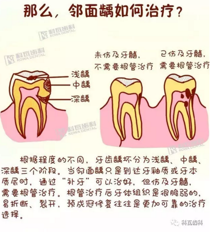 牙縫間的黑線是鄰面齲，還一壞壞倆，巧用它幫你渡過(guò)一“劫”