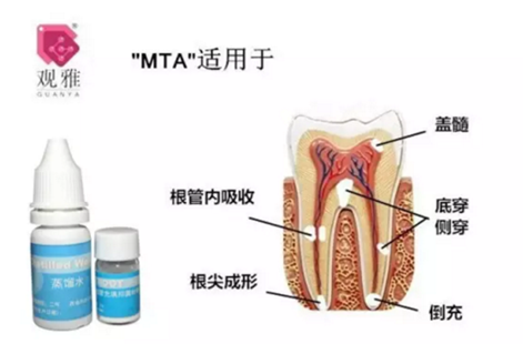 “觀雅”MTA修補側(cè)穿一例