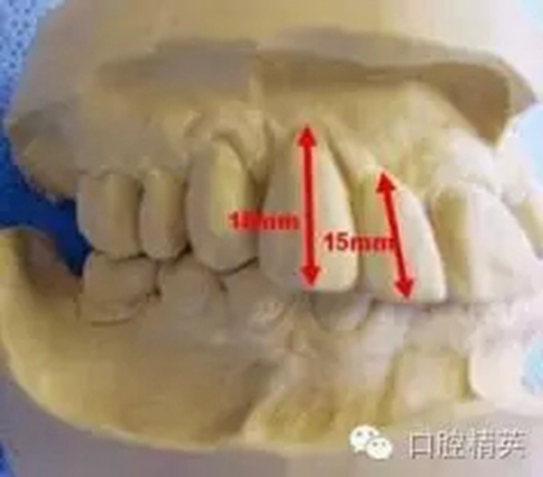 口腔種植各種失敗模式的病因探查