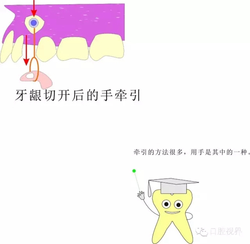 【愛牙科普知識300問】 “什么是頜（牙）墊？”