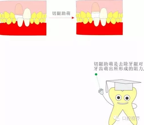  “什么是牙周袋沖洗？”