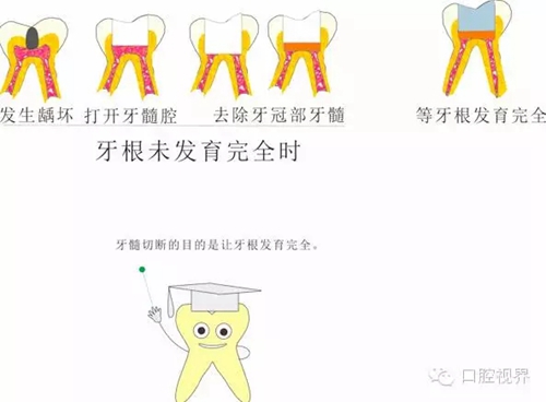 【愛牙科普知識300問】 “什么是活髓切斷術(shù)？”