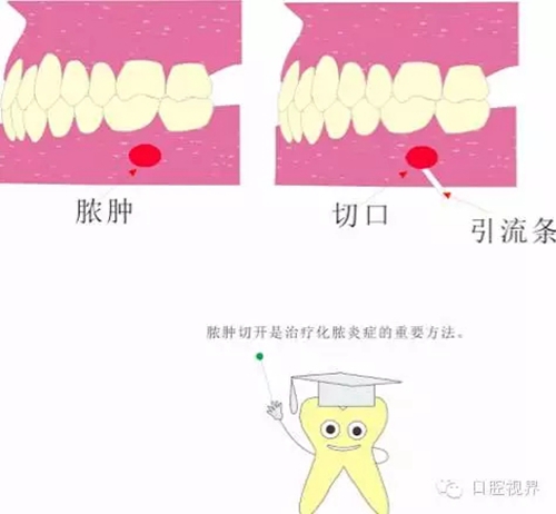 【愛牙科普知識300問】 “什么是活髓切斷術(shù)？”