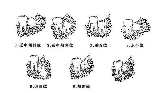 【愛牙科普】長(zhǎng)智齒避免不了，但智齒發(fā)炎我們可以躲過(guò)！