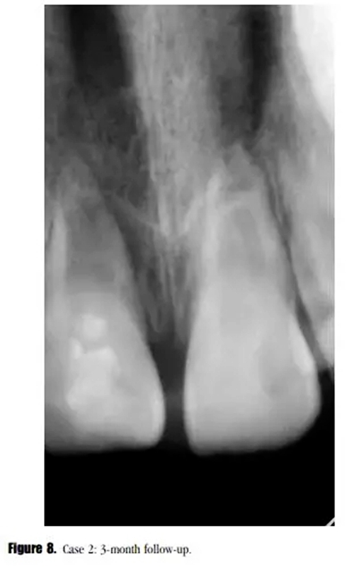 病例分享｜牙髓血管再生治療失敗后的牙根發(fā)育：2例