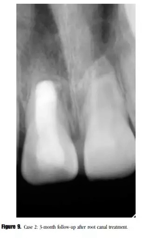病例分享｜牙髓血管再生治療失敗后的牙根發(fā)育：2例