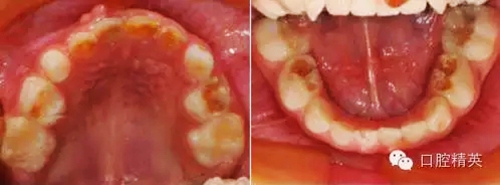 全麻下兒科治療+兒牙樹脂充填