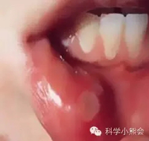 粘液腺囊腫