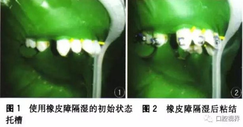 橡皮障，是用還是不用？