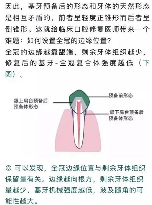 做全冠修復(fù)時(shí)基牙根面暴露，如何備牙？