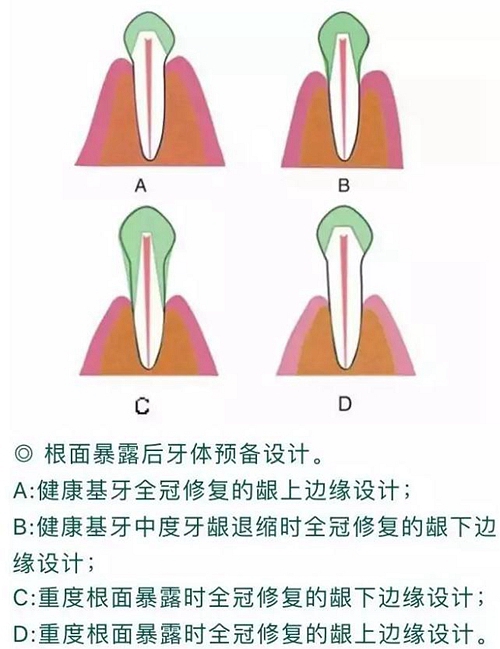 做全冠修復(fù)時(shí)基牙根面暴露，如何備牙？