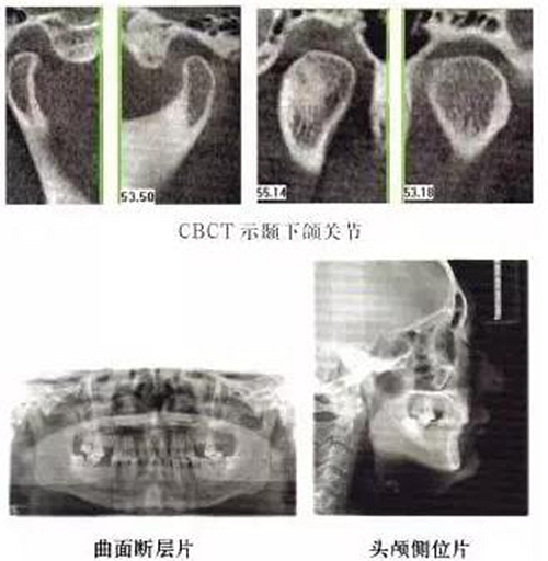 正畸修復聯(lián)合咬合重建1例 